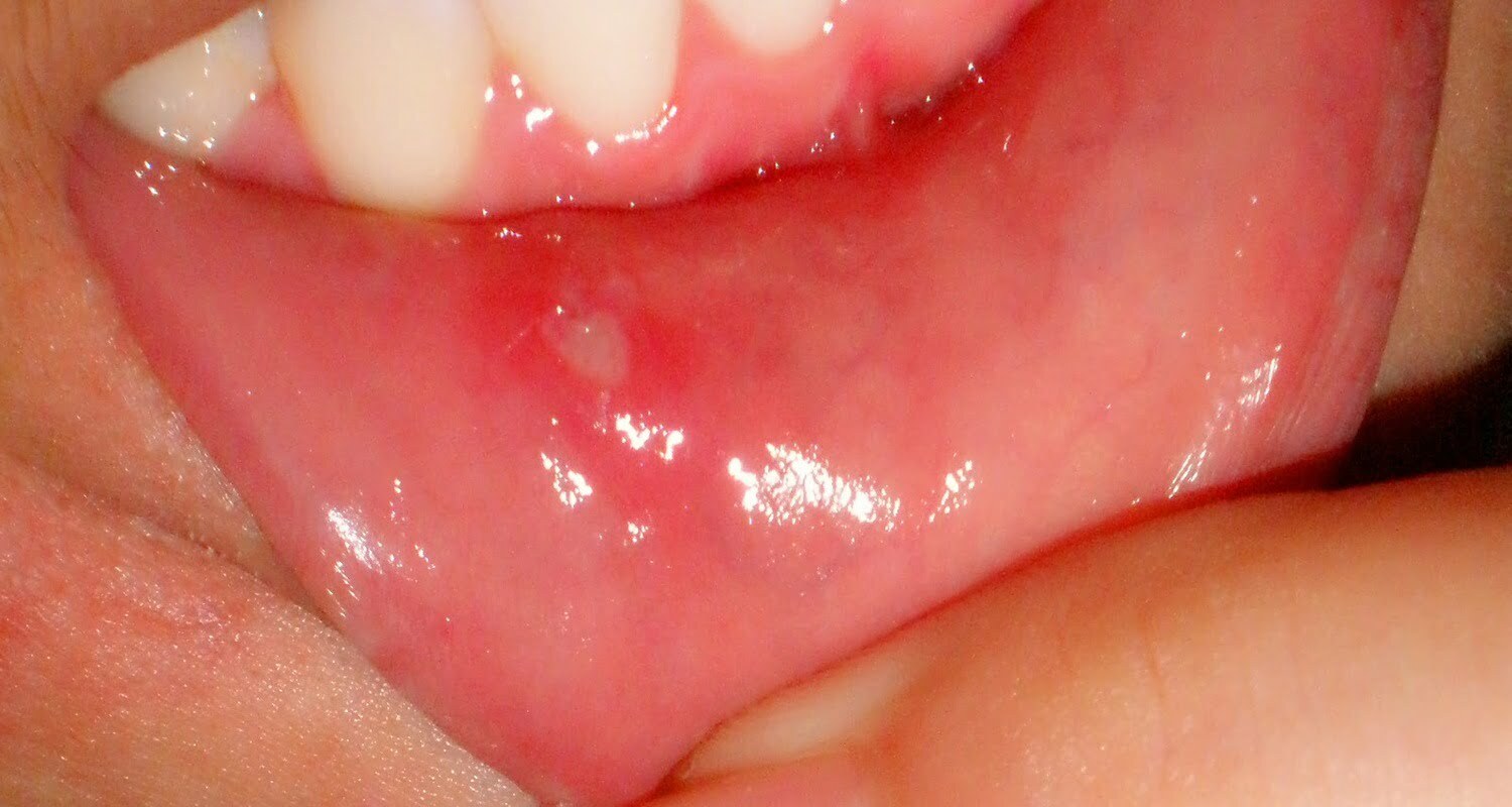 Aphtous ulcer and herpes (mouth wounds)