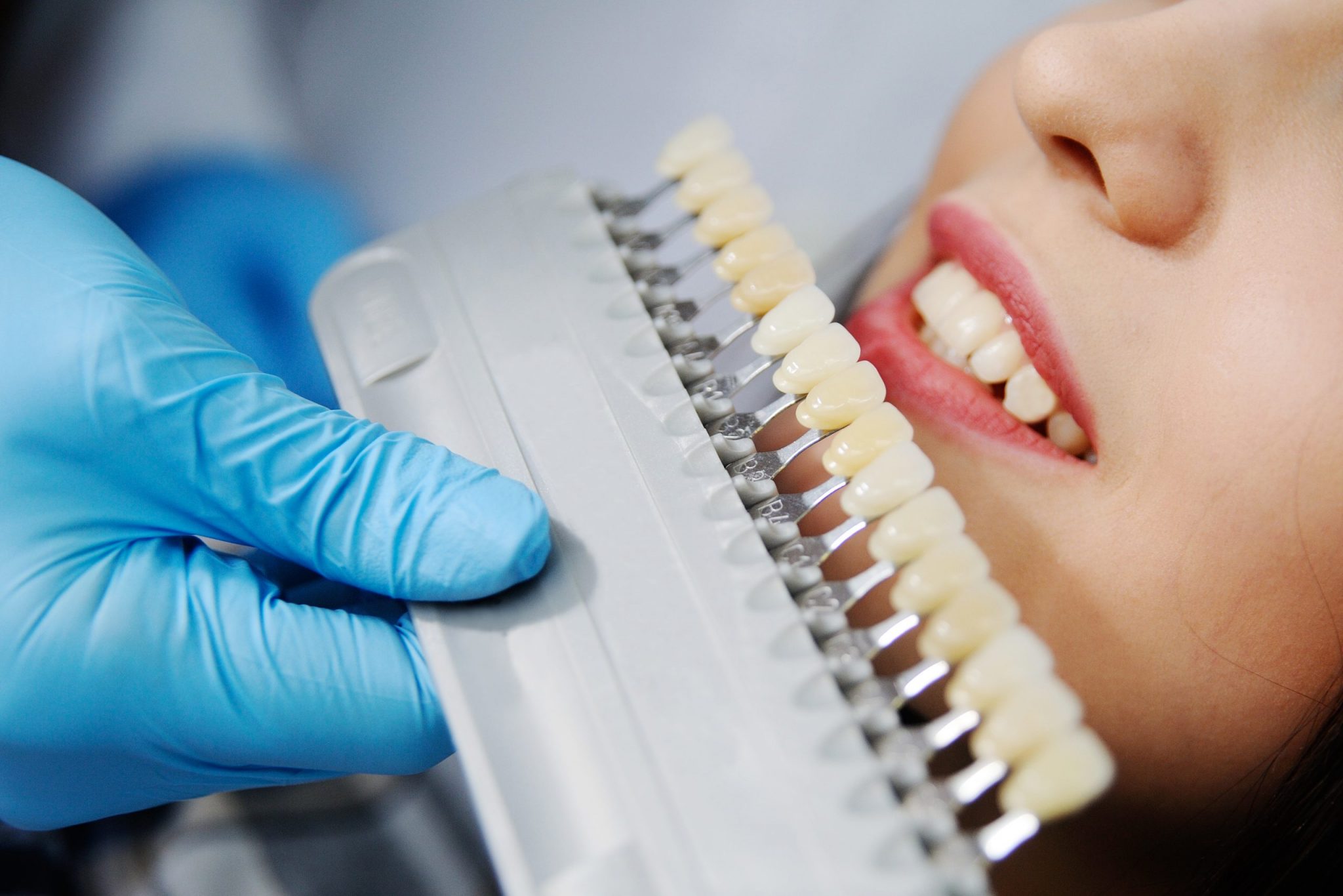Laminate Veener Uygulamaları Dentince Gülüş Tasarımı / Diş Estetiği